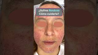 Los 4 mejores tratamientos de la rosácea rosacea rosaceaskincare [upl. by Machute565]