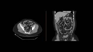 Epiploic Appendagitis [upl. by Lladnarc460]