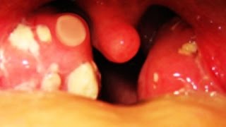 Worlds Greatest Tonsil Stone Removals [upl. by Eerdna]