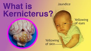 What is Kernicterus kernicterus [upl. by Derfniw]