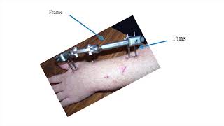 Orthopaedics  fracture management [upl. by Marsden]