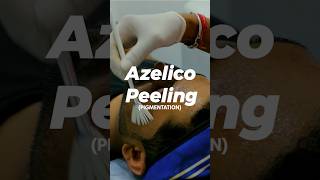 Azelico Peeling Pigmentation  ClearSkin Pune [upl. by Alby]