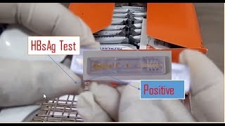 HBsAG Test Positive Hepatitis B test result within 20 minutes Hepatitis B test procedure [upl. by Htrag577]