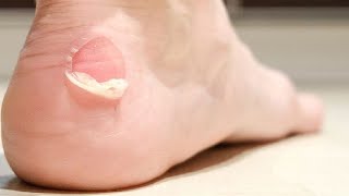 how to get rid of blisters on feet overnight [upl. by Garson]