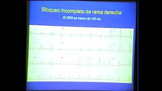 Dr PérezVillacastín Bloqueos de rama hemibloqueos y tratamiento [upl. by Reeva]