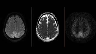 Luxury perfusion of the brain on MRI [upl. by Kitchen]