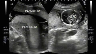 Ultrasound Video showing double placenta in twin pregnancy [upl. by Ocnarfnaig758]