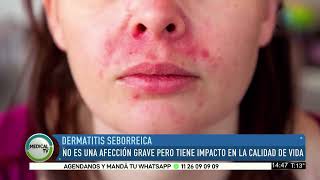 MEDICAL TV Dermatitis Seborreica [upl. by Ahsenahs]