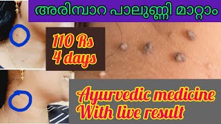 💯4 ദിവസം മതി അരിമ്പാറ പാലുണ്ണി മാറ്റാൻWarts removal creamArimpara removal malayalamwartosin [upl. by Avuha]