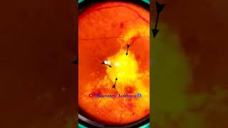 Diabetic retinopathy  Hemorrhages  Hard exudates  Fundus  Short Video 191 [upl. by Levin]