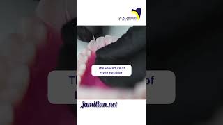 Procedure of Fixed Retainer dentist bracing fixedretainerRetainerOrthodonticsRetention [upl. by Gaby950]