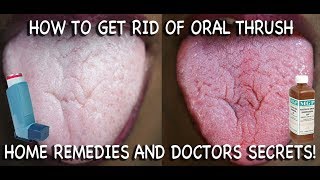 How to Treat Candida at Home Doctors Advice [upl. by Nednal]