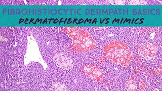 Fibrohistiocytic Dermpath Basics  dermatofibroma amp mimics dermatology dermatopathology pathology [upl. by Anderegg]