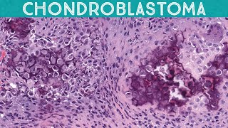 Chondroblastoma with perfect chickenwire calcification Bone pathology basics Yale case 7 [upl. by Younglove563]