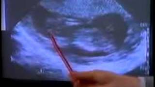 abortion video 3 [upl. by Lauber]