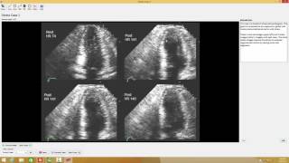 6 Echo Test and Teach Stress Echo Case [upl. by Graeme]