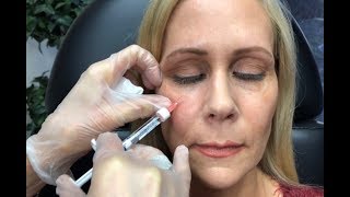 Dermal Filler Under Eyes Tear Trough Restylane and Radiesse [upl. by Rehpotsirhc254]