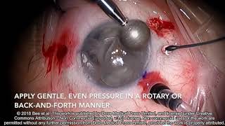 Band keratopathy removal without EDTA  Video S1  177636 [upl. by Fafa]