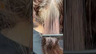 Scalp treatment for severe scalp psoriasis scalptreatment scalppsoriasis scalp [upl. by Onitselec283]