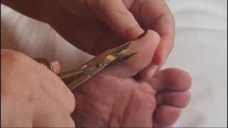 Subscribe for more videos Callus Cutting Saga callus cutting toe callo occhio di pernice [upl. by Ryley]