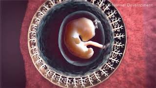 Animated Portrayal of Placenta Accreta Spectrum [upl. by Bela]