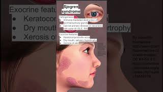 Sjogren syndrome [upl. by Jdavie]