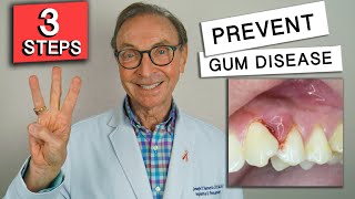 3 Easy Ways to Prevent Gum Disease at Home [upl. by Llet]