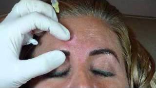 Glabellar Botox Injection Technique  Botox Class [upl. by Anaerol]