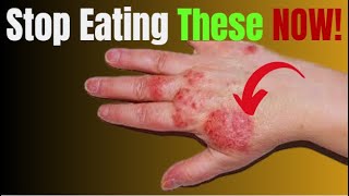 Top 3 Foods You Must Avoid to Heal Eczema Naturally [upl. by Levey69]