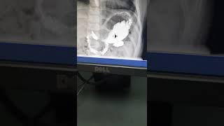 Serie Esófago Gastro Duodenal SEGD en Niños [upl. by Solokin]