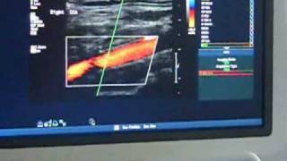 Carotid Doppler Scan [upl. by Ahsetal991]