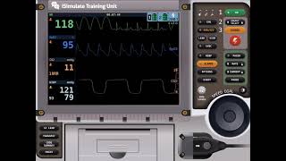 Capnography Waveform with ROSC [upl. by Yseulte]