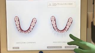 Scanner Intraorale Itero INVISALIGN [upl. by Branham]