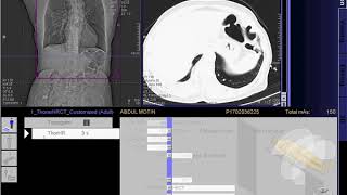 HRCT Scan of Chest full work quot SIEMENSquot [upl. by Weiman61]