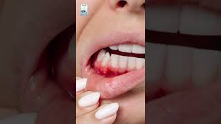 What is mouth ulcers [upl. by Southard]