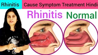 Rhinitis Type Cause Symptom Diagnosis Treatment in Hindi  What is Rhinitis  Treatment of Rhinitis [upl. by Emelda]