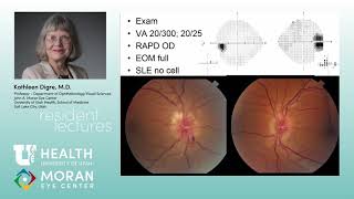 Papilledema  IIH NonIIH Approach to ON Edema [upl. by Roselyn]