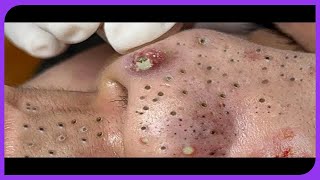 Satisfying Blackhead Removal Popping Pimples and Blackheads on Skin  2024 [upl. by Sauer]