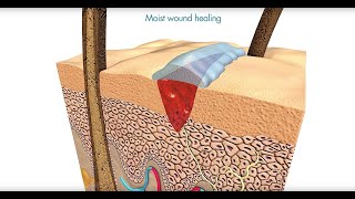 Flamigel  Optimal moist wound healing with Flamigel [upl. by Mair]