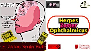 Herpes Zoster Ophthalmicus [upl. by Graces]