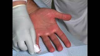 Botox for PALMAR Hyperhidrosis sweatypalms Dr David Pariser International Hyperhidrosis Society© [upl. by Forcier]