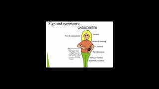 Cholecystitis digestive system disorder [upl. by Philo]