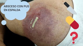 ABSCESO CON PUS EN ESPALDA [upl. by Ydolem]