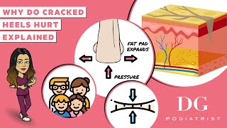 Why do cracked heels hurtCracked heels treatment series The Foot Scraper DG Podiatrist [upl. by Fawn]