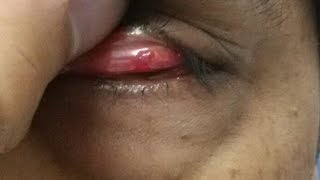 Conjunctival Granuloma [upl. by Aratal]