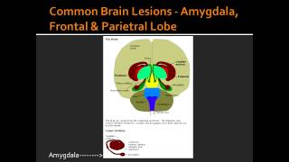 Common Brain Lesions  Amygdala Frontal amp Parietral Lobe [upl. by Chrissy]