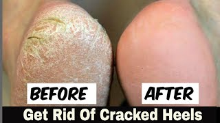 Home Remedy to Remove Cracked Heels Fast quotOVERNIGHTquot  Great Results [upl. by Romola]