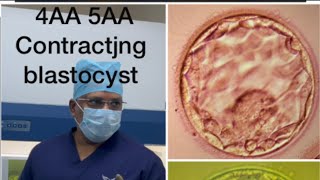 Ivf ICSIblastocyst 4AA expanded blast 5AA hatching blastocyst poor blastocyst embryo biopsyivf [upl. by Sedinoel]