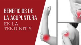 Beneficios de la Acupuntura en la Tendinitis [upl. by Chapin]