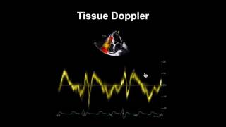 What is an Echogenic Intracardiac Focus how serious is an Echogenic Intracardiac Focus in fetus [upl. by Melgar]